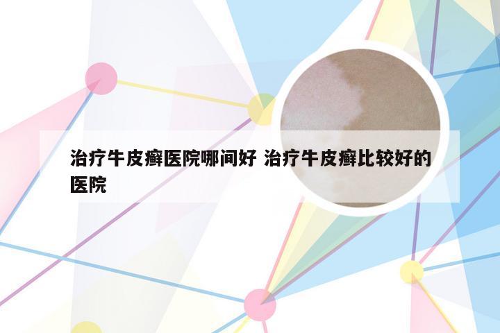 治疗牛皮癣医院哪间好 治疗牛皮癣比较好的医院