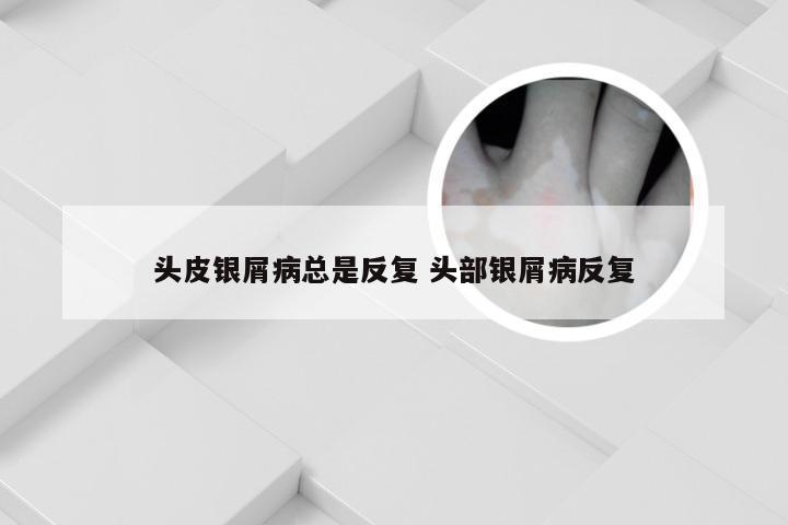 头皮银屑病总是反复 头部银屑病反复