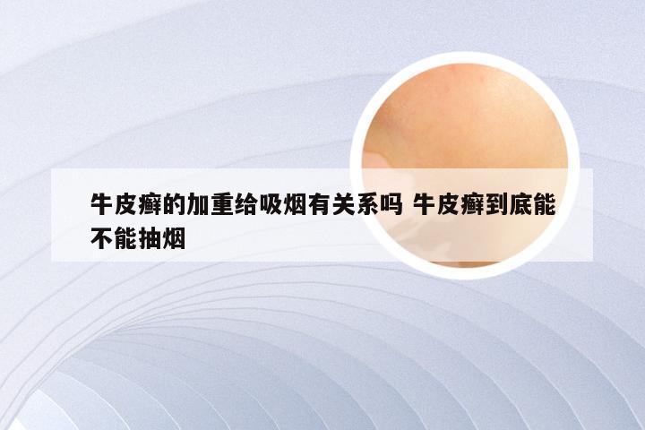 牛皮癣的加重给吸烟有关系吗 牛皮癣到底能不能抽烟