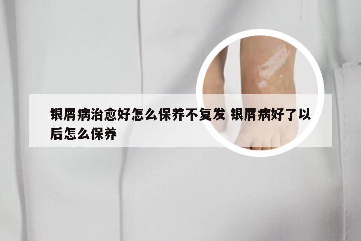 银屑病治愈好怎么保养不复发 银屑病好了以后怎么保养