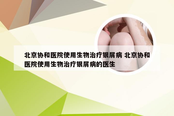 北京协和医院使用生物治疗银屑病 北京协和医院使用生物治疗银屑病的医生