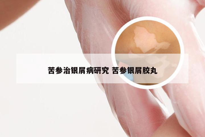 苦参治银屑病研究 苦参银屑胶丸