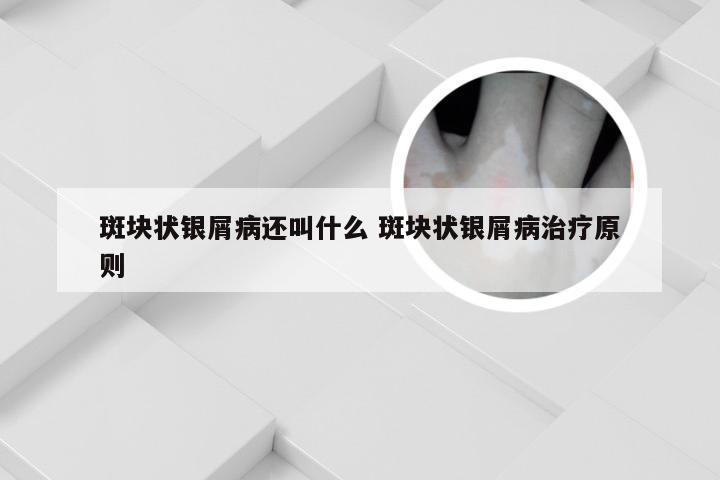 斑块状银屑病还叫什么 斑块状银屑病治疗原则