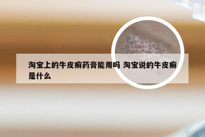 淘宝上的牛皮癣药膏能用吗 淘宝说的牛皮癣是什么