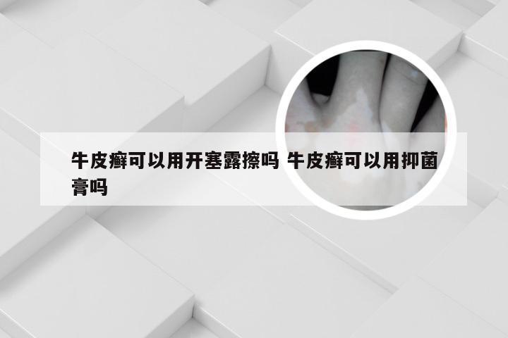 牛皮癣可以用开塞露擦吗 牛皮癣可以用抑菌膏吗