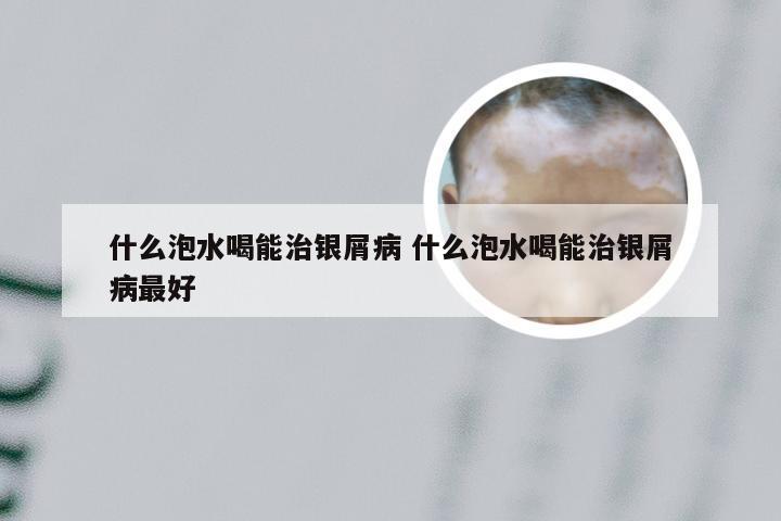 什么泡水喝能治银屑病 什么泡水喝能治银屑病最好