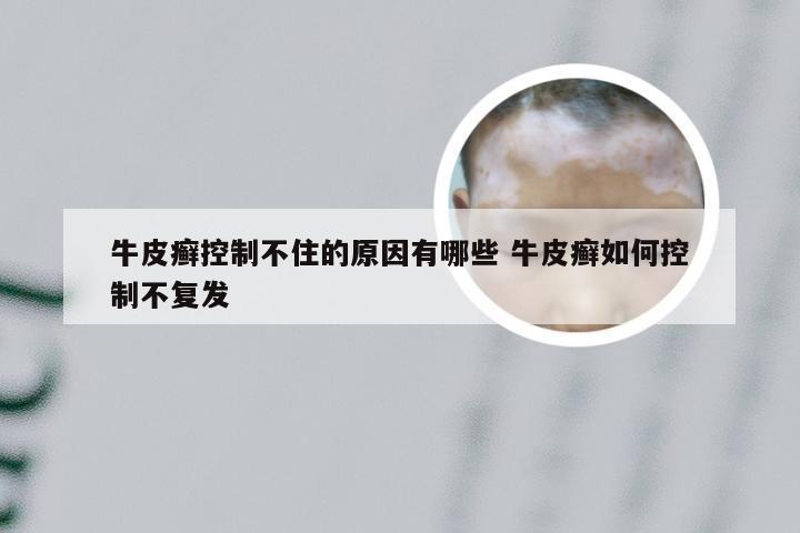 牛皮癣控制不住的原因有哪些 牛皮癣如何控制不复发