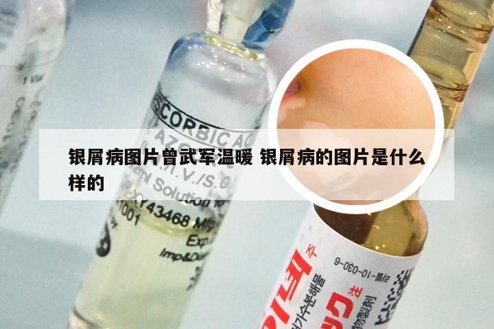 银屑病图片曾武军温暖 银屑病的图片是什么样的