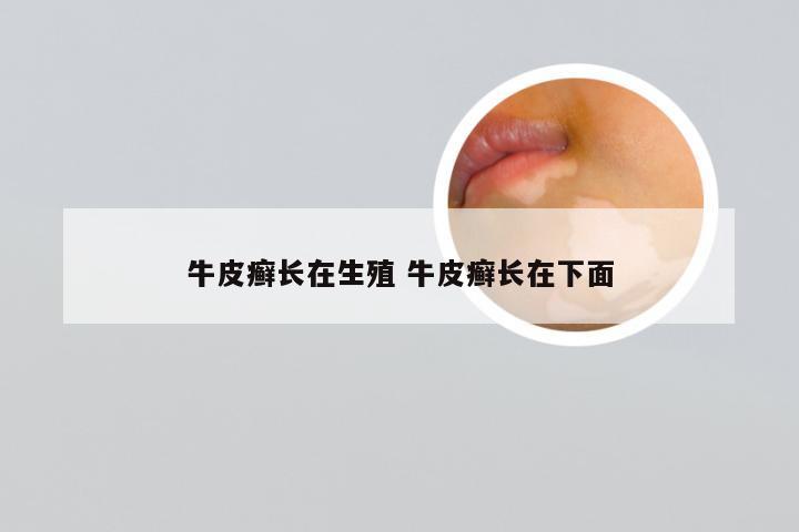 牛皮癣长在生殖 牛皮癣长在下面