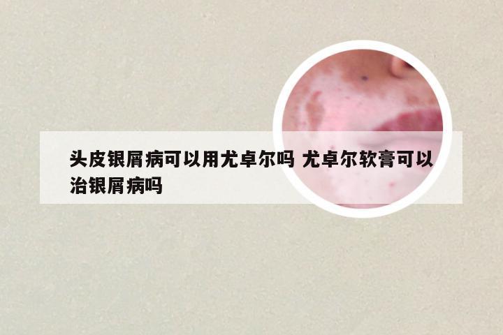 头皮银屑病可以用尤卓尔吗 尤卓尔软膏可以治银屑病吗