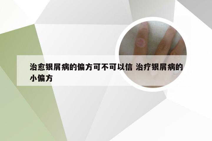 治愈银屑病的偏方可不可以信 治疗银屑病的小偏方