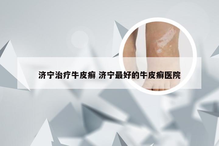 济宁治疗牛皮癣 济宁最好的牛皮癣医院