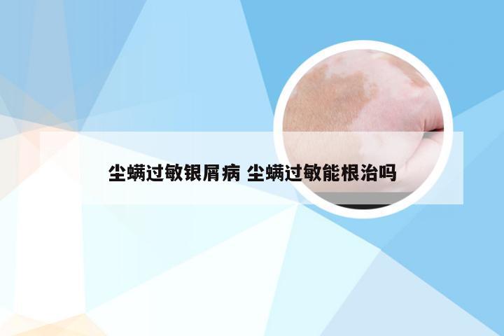 尘螨过敏银屑病 尘螨过敏能根治吗
