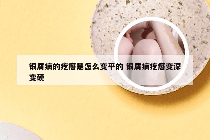 银屑病的疙瘩是怎么变平的 银屑病疙瘩变深变硬