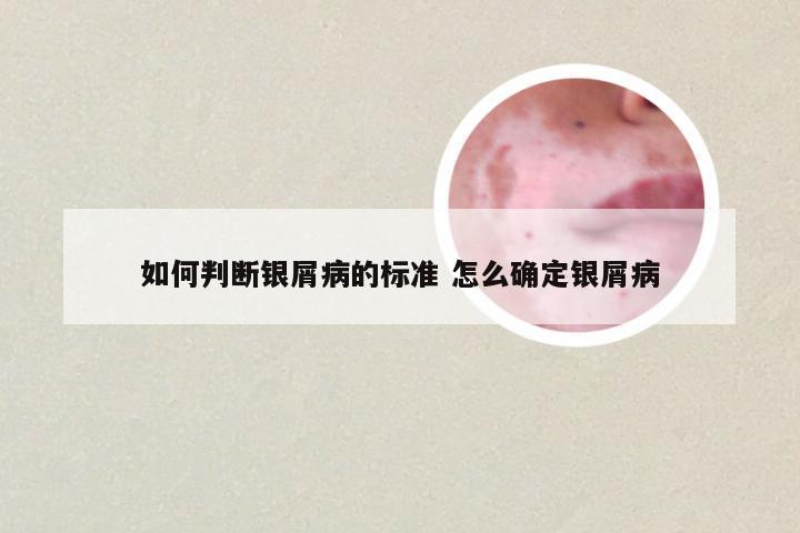如何判断银屑病的标准 怎么确定银屑病