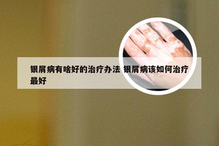 银屑病有啥好的治疗办法 银屑病该如何治疗最好