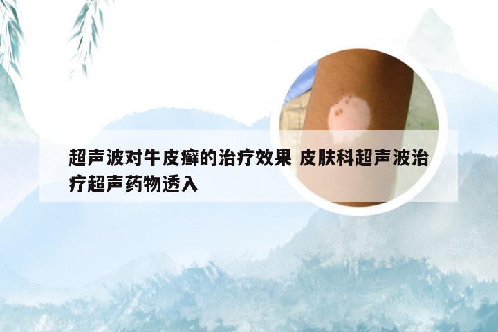 超声波对牛皮癣的治疗效果 皮肤科超声波治疗超声药物透入