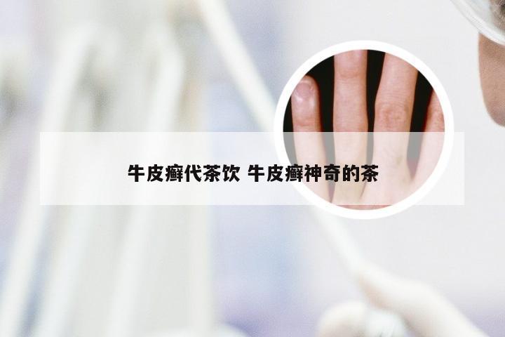 牛皮癣代茶饮 牛皮癣神奇的茶