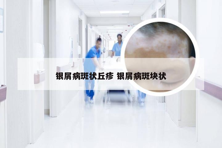 银屑病斑状丘疹 银屑病斑块状