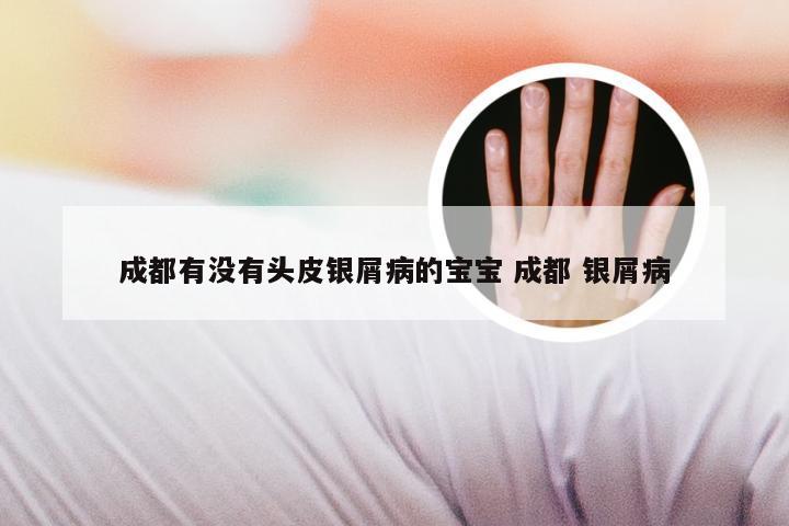 成都有没有头皮银屑病的宝宝 成都 银屑病