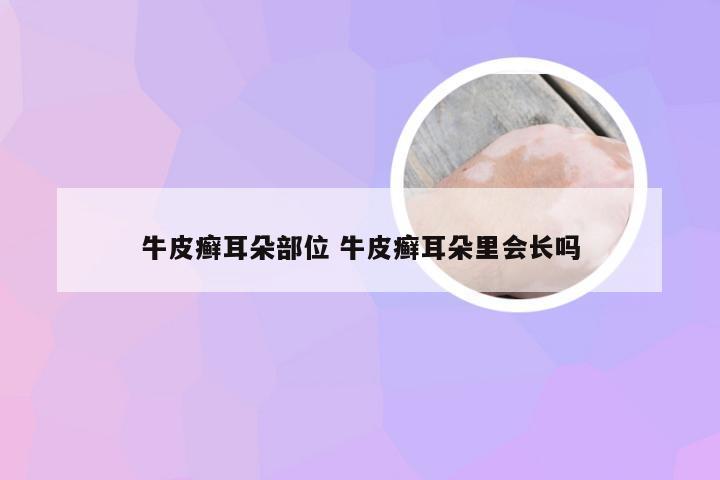 牛皮癣耳朵部位 牛皮癣耳朵里会长吗