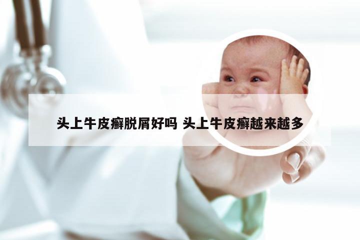 头上牛皮癣脱屑好吗 头上牛皮癣越来越多