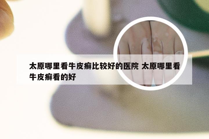 太原哪里看牛皮癣比较好的医院 太原哪里看牛皮癣看的好