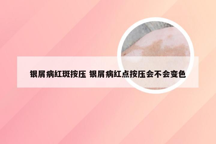 银屑病红斑按压 银屑病红点按压会不会变色