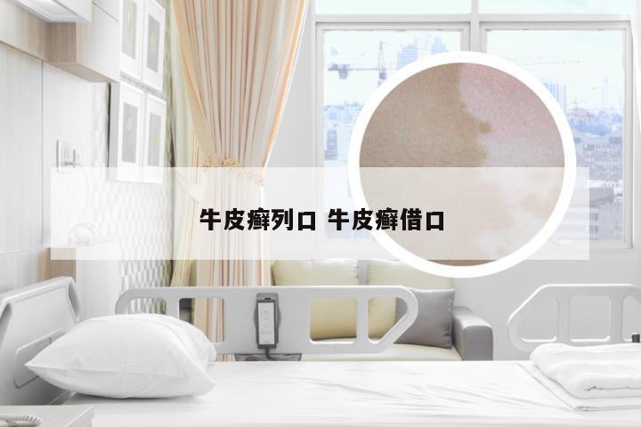 牛皮癣列口 牛皮癣借口