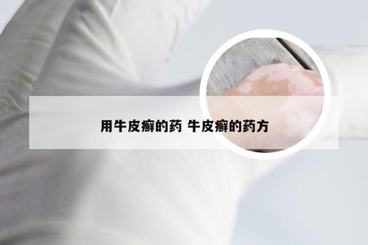 用牛皮癣的药 牛皮癣的药方