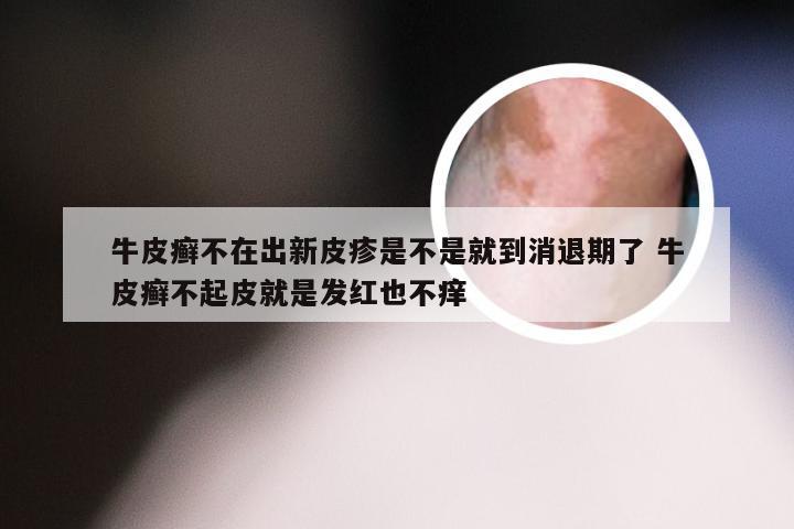 牛皮癣不在出新皮疹是不是就到消退期了 牛皮癣不起皮就是发红也不痒