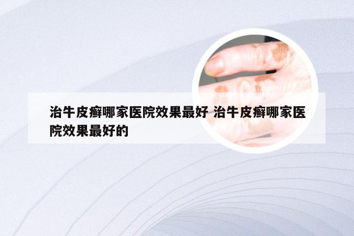 治牛皮癣哪家医院效果最好 治牛皮癣哪家医院效果最好的