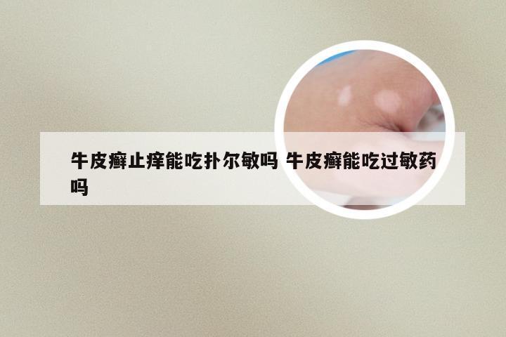 牛皮癣止痒能吃扑尔敏吗 牛皮癣能吃过敏药吗