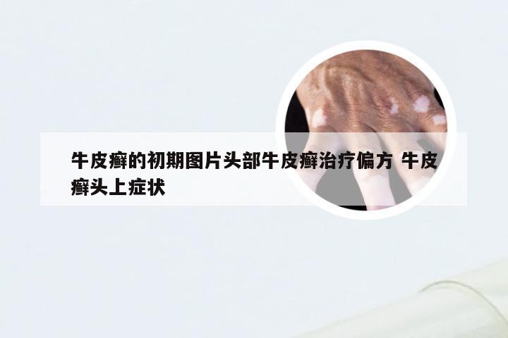 牛皮癣的初期图片头部牛皮癣治疗偏方 牛皮癣头上症状