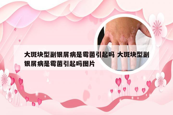 大斑块型副银屑病是霉菌引起吗 大斑块型副银屑病是霉菌引起吗图片