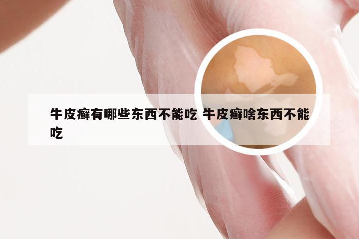牛皮癣有哪些东西不能吃 牛皮癣啥东西不能吃
