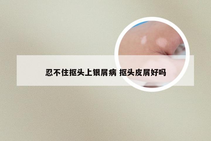 忍不住抠头上银屑病 抠头皮屑好吗