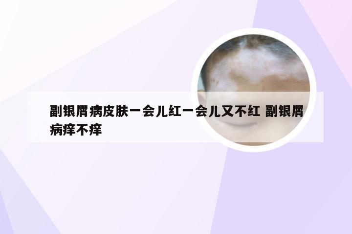 副银屑病皮肤一会儿红一会儿又不红 副银屑病痒不痒