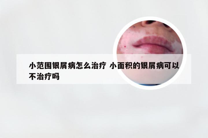 小范围银屑病怎么治疗 小面积的银屑病可以不治疗吗