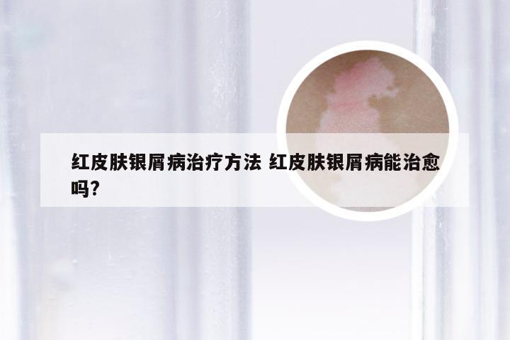 红皮肤银屑病治疗方法 红皮肤银屑病能治愈吗?