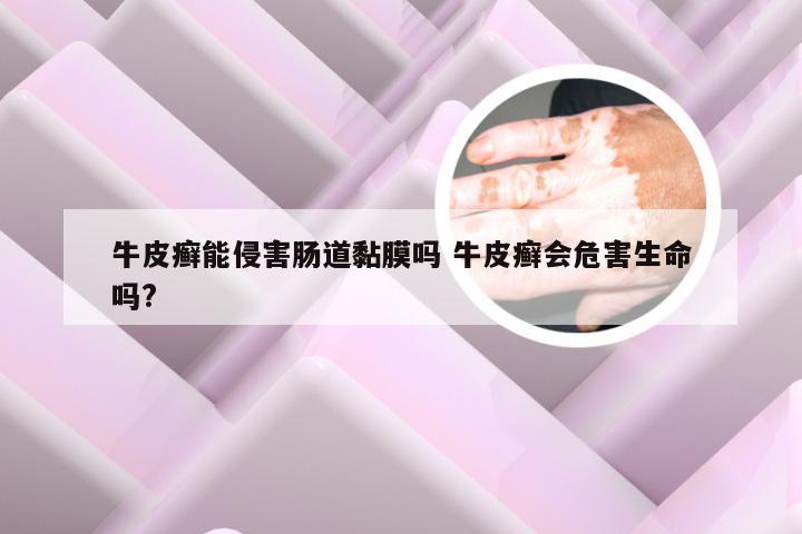 牛皮癣能侵害肠道黏膜吗 牛皮癣会危害生命吗?