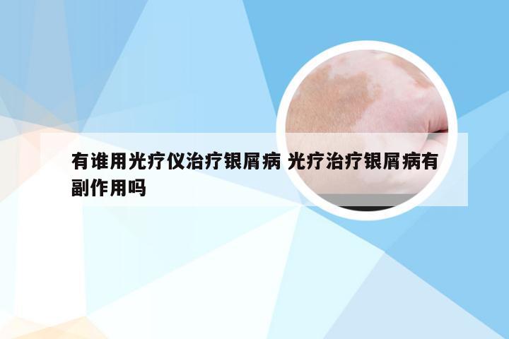 有谁用光疗仪治疗银屑病 光疗治疗银屑病有副作用吗