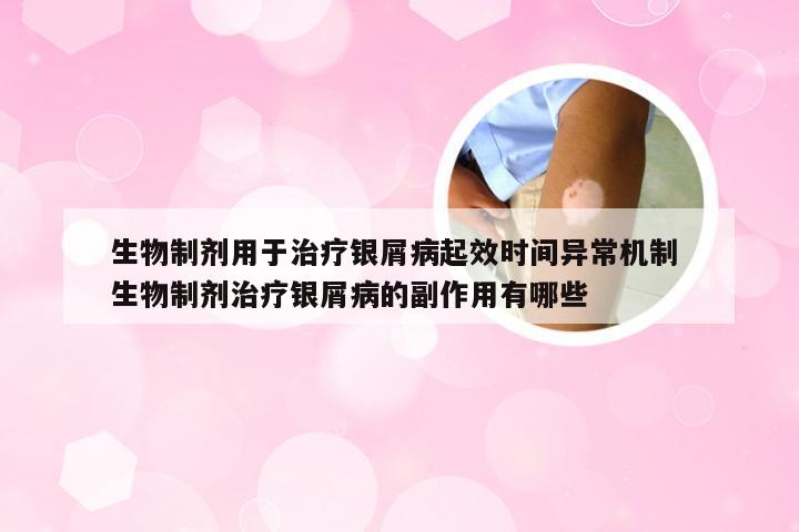 生物制剂用于治疗银屑病起效时间异常机制 生物制剂治疗银屑病的副作用有哪些
