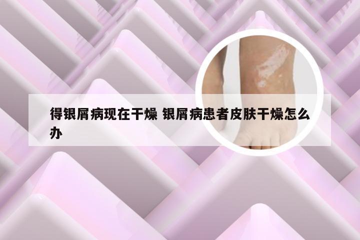 得银屑病现在干燥 银屑病患者皮肤干燥怎么办