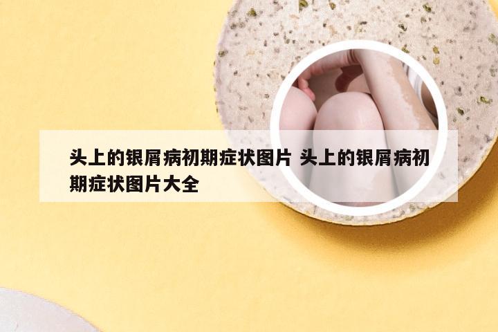 头上的银屑病初期症状图片 头上的银屑病初期症状图片大全