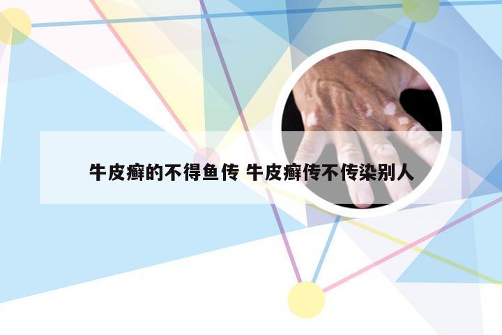 牛皮癣的不得鱼传 牛皮癣传不传染别人