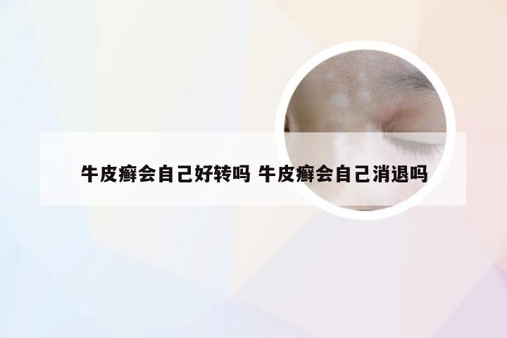牛皮癣会自己好转吗 牛皮癣会自己消退吗