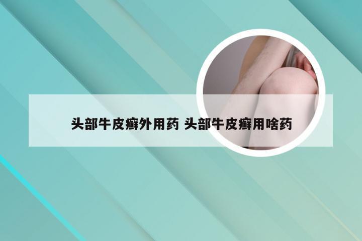 头部牛皮癣外用药 头部牛皮癣用啥药
