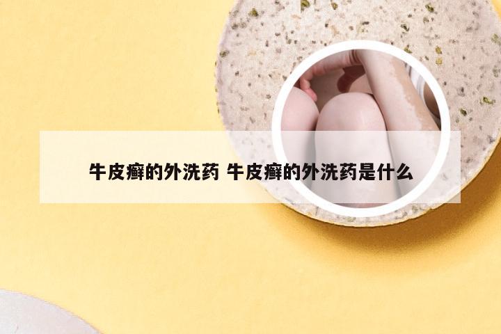 牛皮癣的外洗药 牛皮癣的外洗药是什么