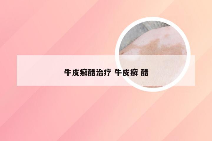 牛皮癣醋治疗 牛皮癣 醋